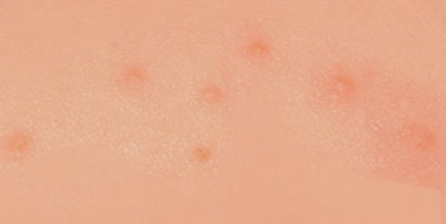 dust mite bite image
